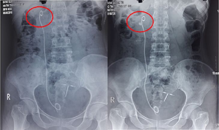 Sau khi làm các xét nghiệm tôi được chẩn đoán mắc bệnh sỏi thận