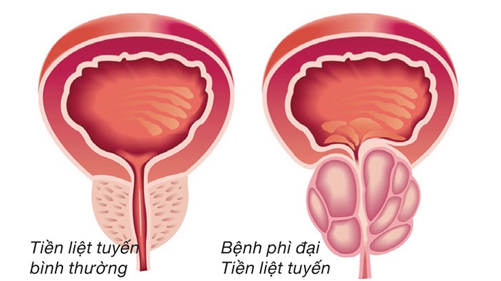 nhất nam tiền liệt đan chữa tiền liệt tuyến 