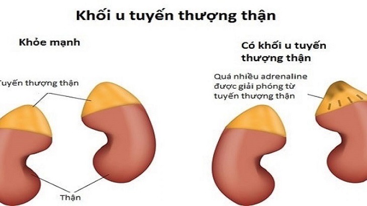 Bệnh lý này có thể gây ra nhiều biến chứng nguy hiểm