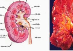 Viêm đài bể thận là tình trạng nhiễm trùng do vi khuẩn, virus gây ra và có thể để lại biến chứng nghiêm trọng