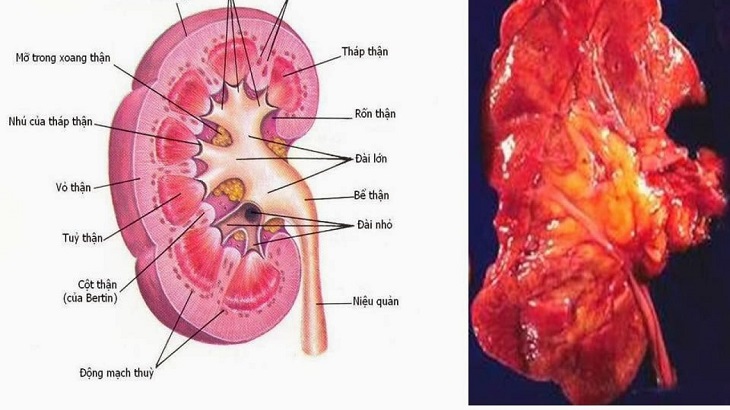 Viêm đài bể thận là tình trạng nhiễm trùng do vi khuẩn, virus gây ra và có thể để lại biến chứng nghiêm trọng