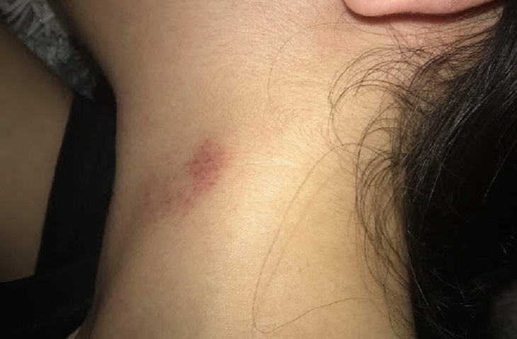 hickey