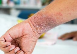 Bệnh chàm (Eczema) không quá nguy hiểm nhưng lại gây nhiều bất tiện trong cuộc sống