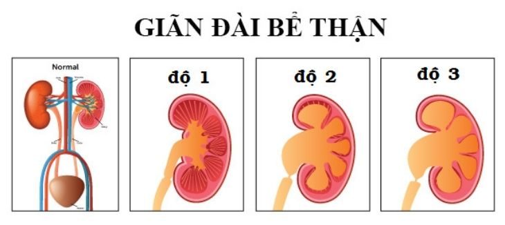 Bệnh tiến triển theo nhiều cấp độ khác nhau