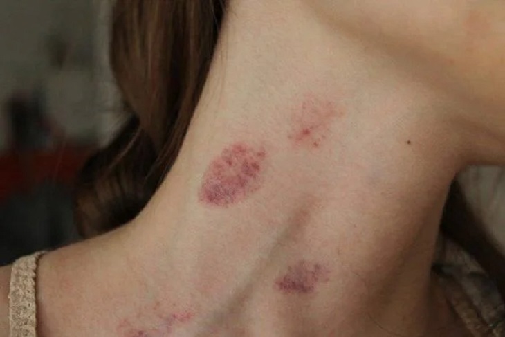 Nốt Hickey Là Gì? Khái Niệm, Cách Tạo Và Các Lưu Ý Quan Trọng