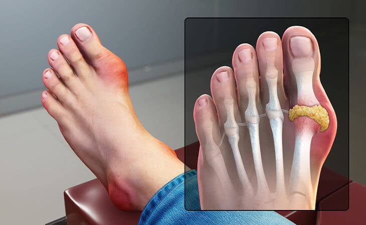 Bệnh gout có thể gây sưng đau ngón chân do axit uric tích tụ trong khớp