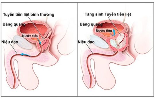 Tăng sản tuyến tiền liệt là gì? Phương pháp chẩn đoán và điều trị