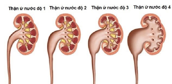 Thận ứ nước có 4 cấp độ bệnh