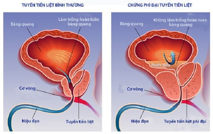 chua phi dai tien liet tuyen bang thuoc nam