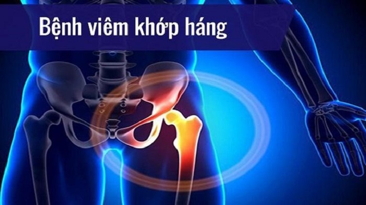 Viêm khớp háng bên phải