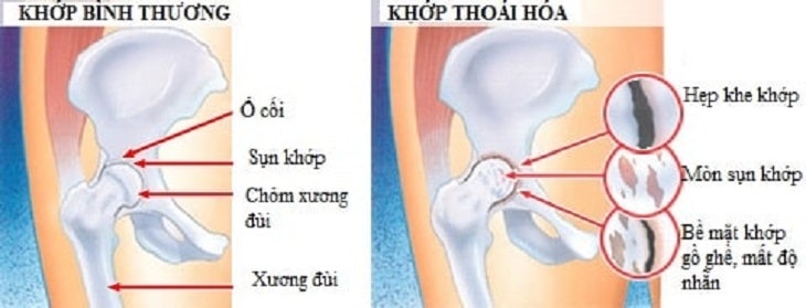 Nguyên nhân đau khớp háng bên phải