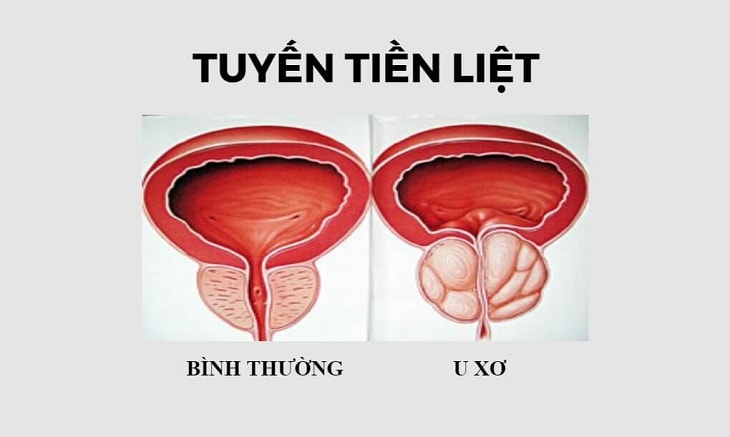 mo phi dai tien liet tuyen