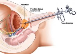 mổ phì đại tiền liệt tuyến