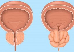 phì đại tiền liệt tuyến