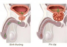 thuốc đặc trị phì đại tiền liệt tuyến