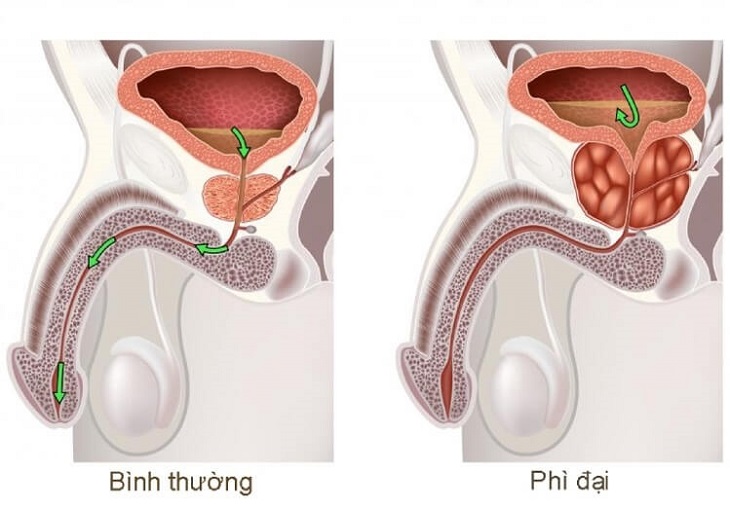 u phi dai tien liet tuyen