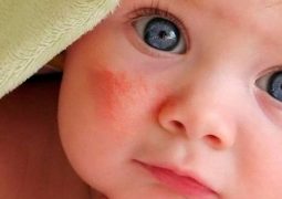 Chàm đỏ ở trẻ sơ sinh là một tình trạng khá phổ biến