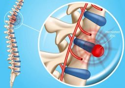 chữa thoát vị đĩa đệm