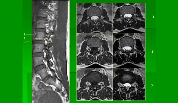 mri thoat vi dia dem