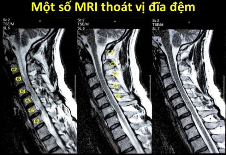 mri thoat vi dia dem