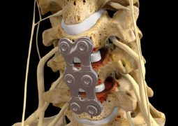 Phẫu thuật thoát vị đĩa đệm cột sống thắt lưng là một trong những phương pháp điều trị hiện nay