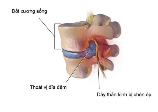 Thoát vị đĩa đệm chèn dây thần kinh nguy hiểm thế nào? Dấu hiệu và cách điều trị