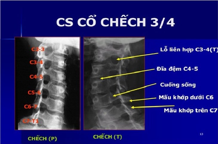 chup x quang thoat vi dia dem