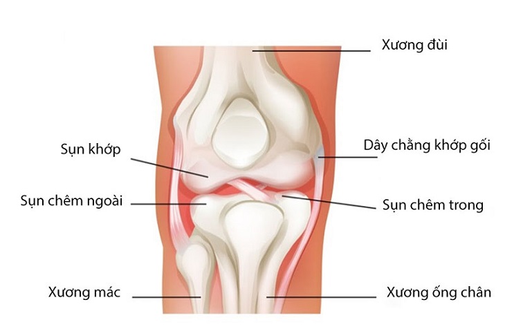 Rách sụn chêm khớp gối xảy xa chủ yếu do chấn thương hoặc tay nạn