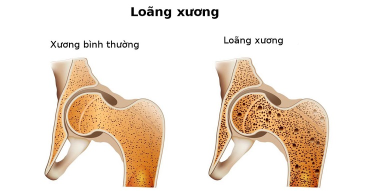 Sự khác biệt của xương của người bình thường so với người bị loãng xương