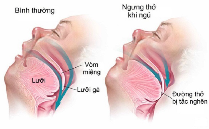 Khi ngủ bị nhưng thở là bệnh lý nguy hiểm liên quan đến hô hấp