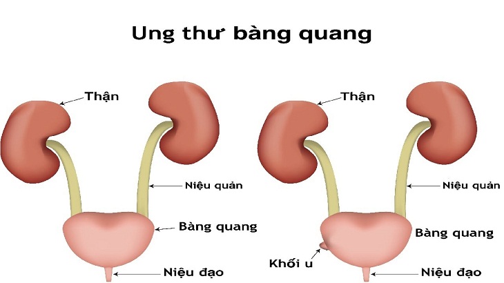 tieu rat dau bung duoi