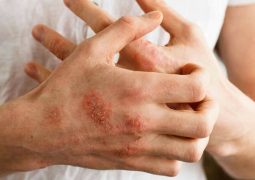 Viêm da cơ địa ở tay là bệnh gì và triệu chứng thường gặp