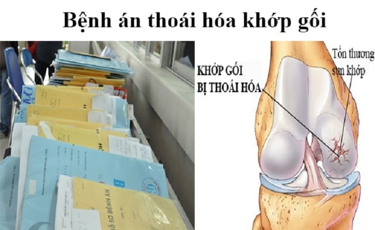 thoai hoa khop goi