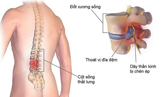 Thoái hóa cột sống chèn dây thần kinh là biểu hiện rất phổ biến của bệnh lý này