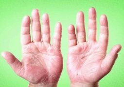 Á sừng gây nhiều phiền toái cho người bệnh