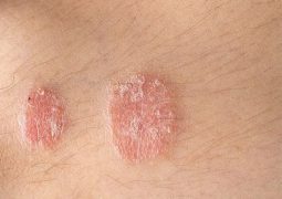 Vảy nến có thể ảnh hưởng tới thẩm mỹ và gây nhiều biến chứng nguy hiểm