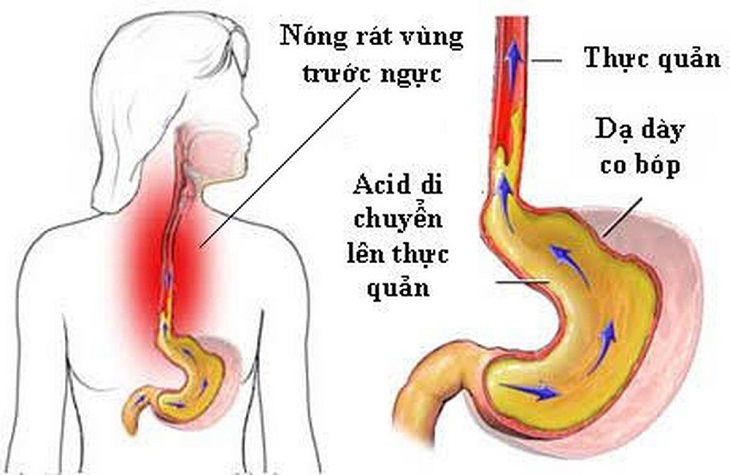 viem hang vi trao nguoc thuc quan