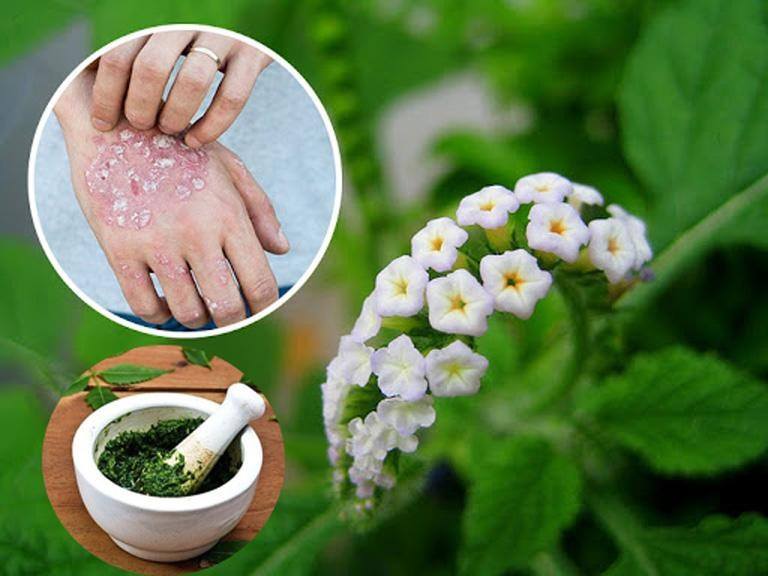 Chi Tiết Cách Dùng Cây Vòi Voi Chữa Vảy Nến An Toàn Lành Tính