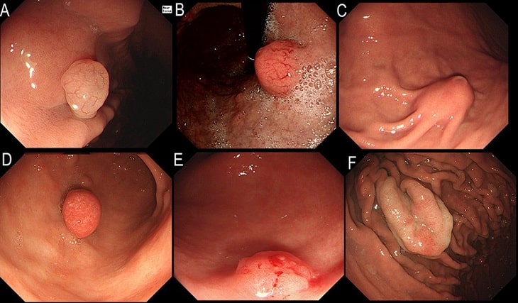 polyp hang vi da day