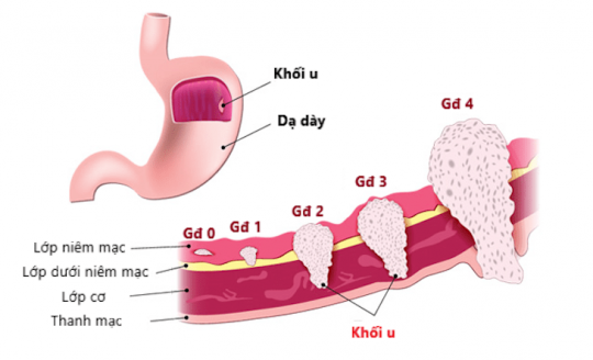 Các giai đoạn phát triển của bệnh lý ung thư dạ dày