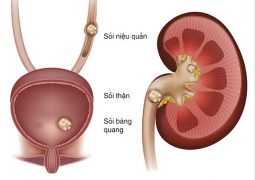 SỎI NIỆU QUẢN – Nguyên Nhân, Triệu Chứng Và CÁCH ĐIỀU TRỊ HIỆU QUẢ