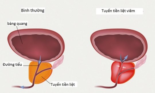 Viêm tuyến tiền liệt ở nữ là tình trạng có thể xảy ra