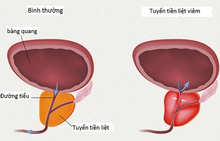 xet nghiem viem tuyen tien liet