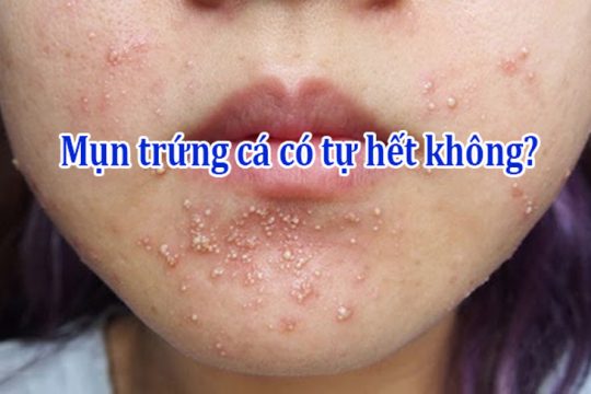 mụn trứng cá có tự hết không