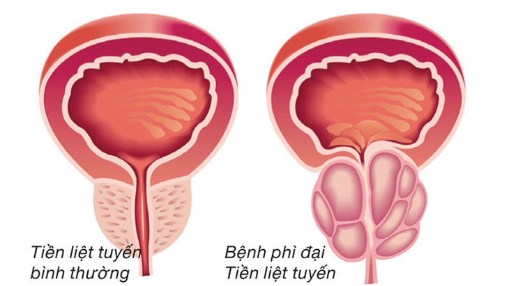 voi hoa tien liet tuyen