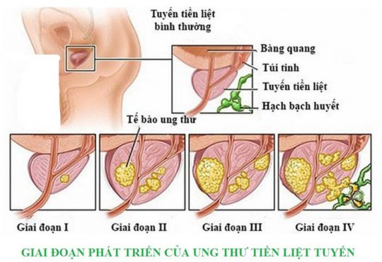 các giai đoạn ung thư tuyến tiền liệt