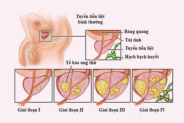 ung thu tuyen tien liet song duoc bao lau