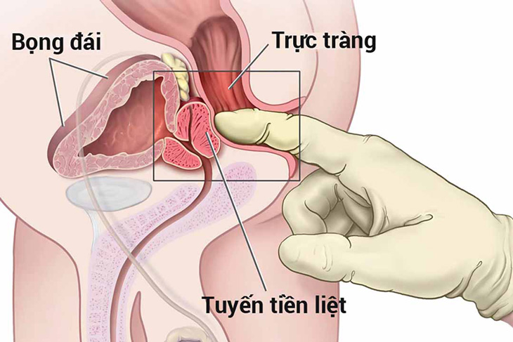 ung thu tuyen tien liet song duoc bao lau