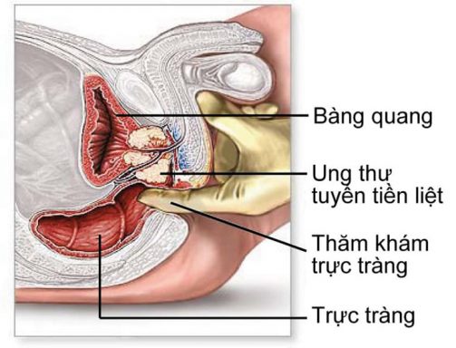 ung thư tuyến tiền liệt sống được bao lâu