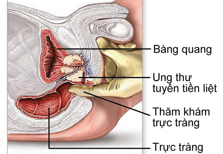 xa tri ung thu tuyen tien liet